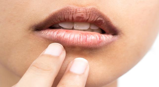 tips yang harus dilakukan untuk mengatasi bibir kering